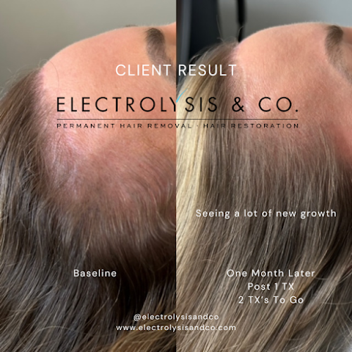Electrolysis & Co. - Permanent Hair Removal | TED Hair Restoration