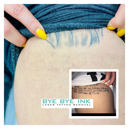 Bye Bye Ink Laser Tattoo Removal